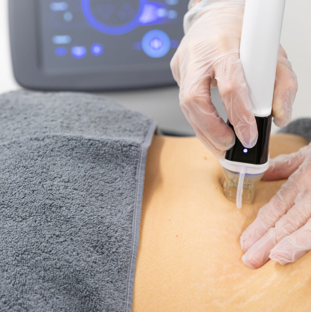 3D Dermaforce Microneedling Radiofrequency - 3D Aesthetics Knowle
